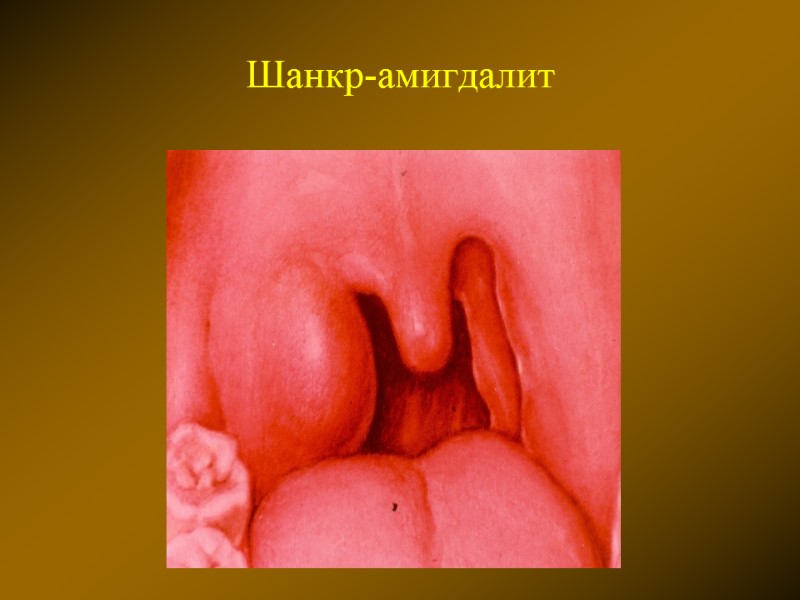 Шанкр-амигдалит